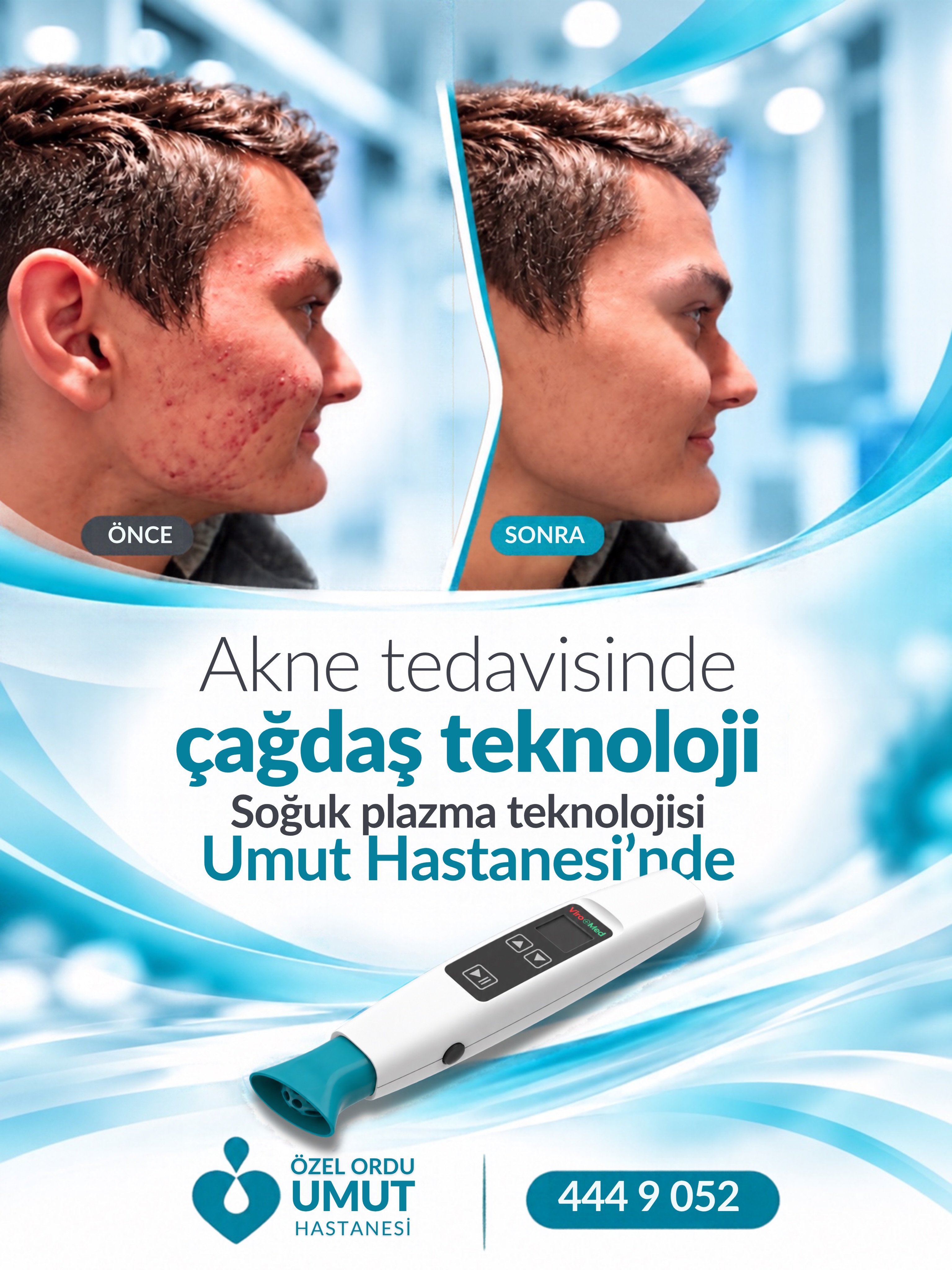 Akne tedavisinde çağdaş teknoloji, sağlıklı bir cilt için yeni bir yaklaşım! ✨